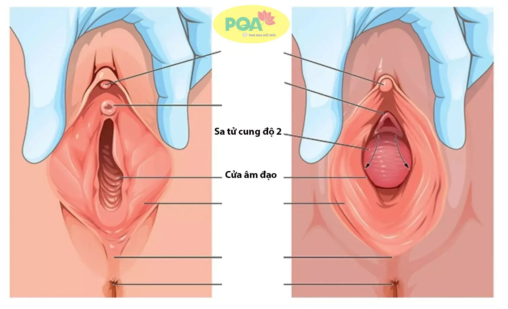 Mẫu sờ thấy cổ tử cung thứ 7