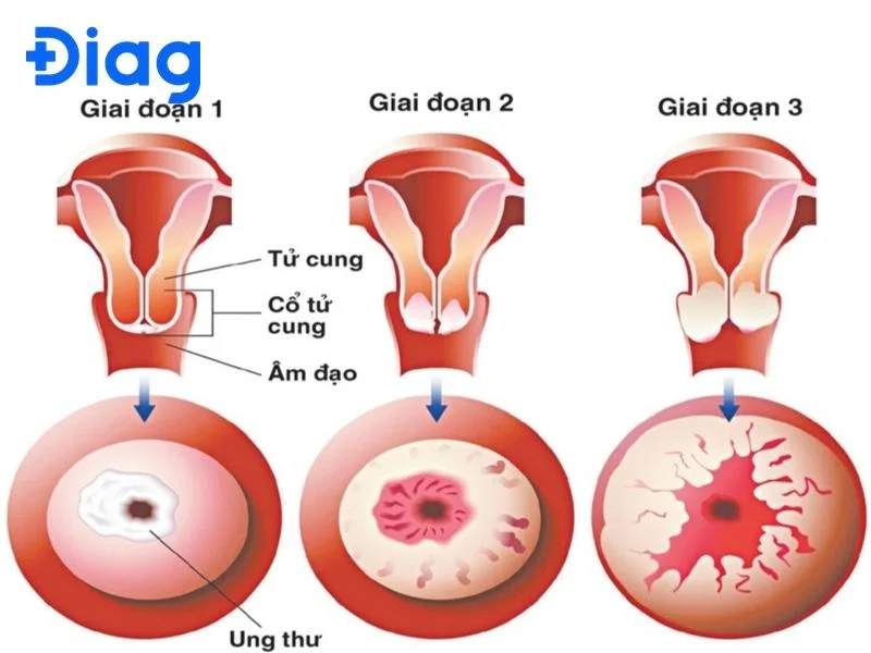 siêu âm có phát hiện ung thư cổ tử cung