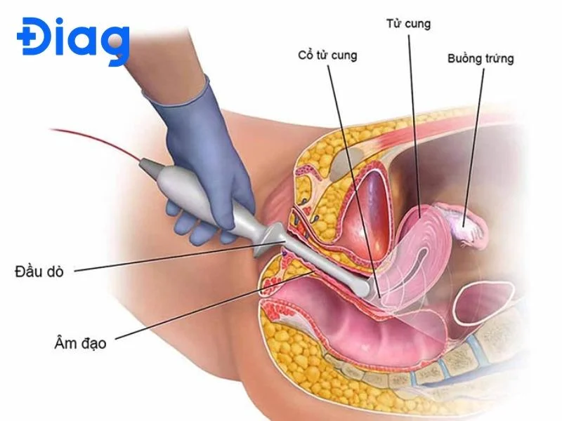 sờ thấy cổ tử cung - mẫu 93