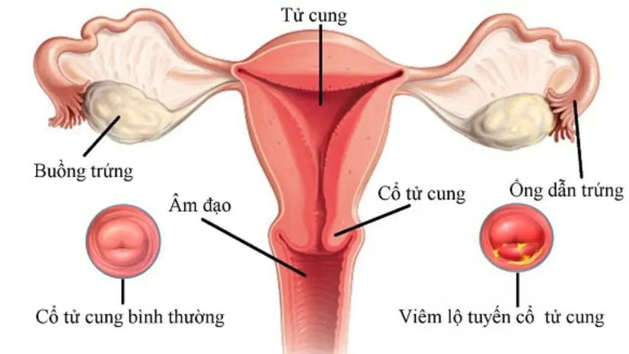 (Hình 2 - Hình minh hoạ mô tả về cấu trúc tử cung)
